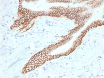 FFPE human pancreatic carcinoma sections stained with 100 ul anti-TROP2 (clone TACSTD2/2153) at 1:400. HIER epitope retrieval prior to staining was performed in 10mM Citrate, pH 6.0.